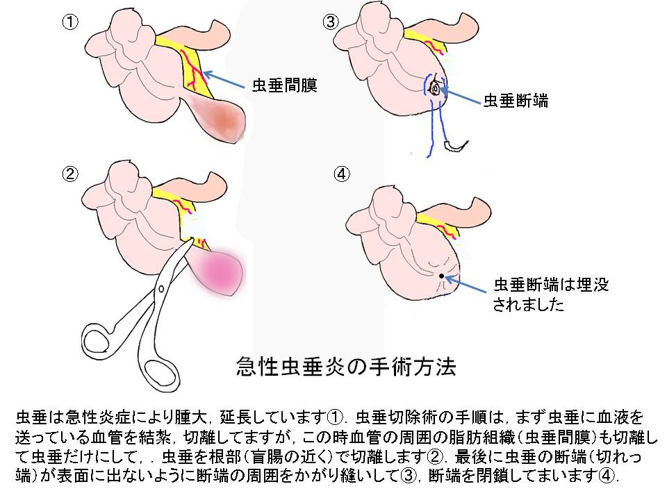 原因 虫垂炎