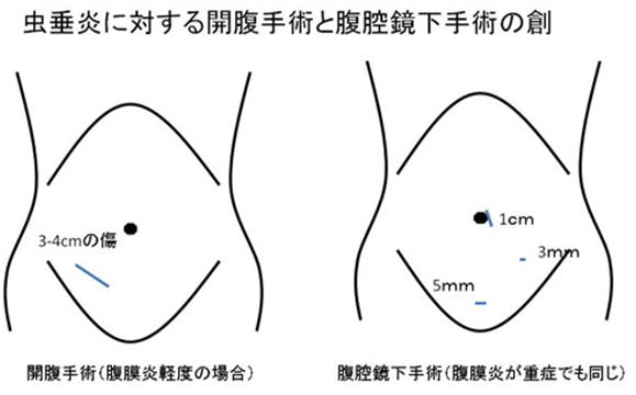 どっち 左 盲腸 右