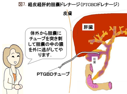 症状 急性 胆嚢 炎 急性胆嚢炎の原因と症状とは？右上腹部に鈍い痛みが現れる