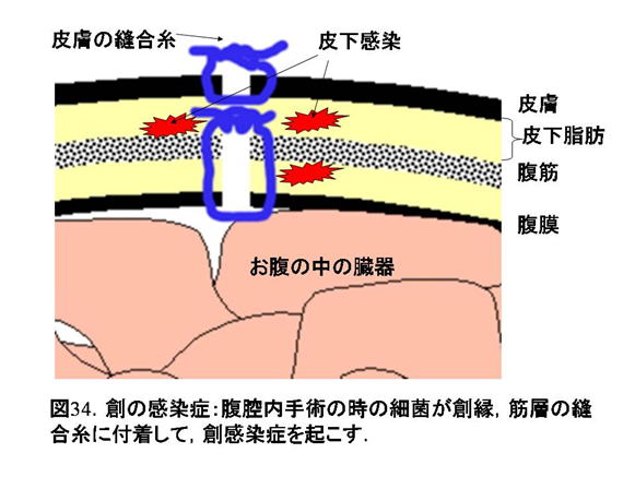 開腹 手術 腹筋