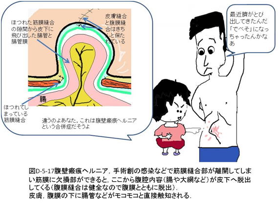 開腹 手術 腹筋