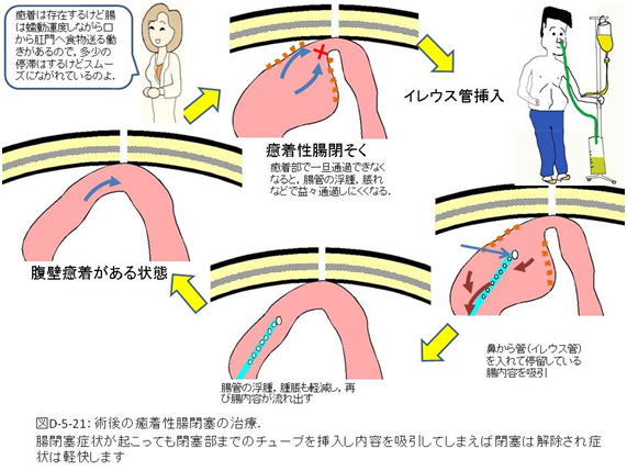 開腹 手術 腹筋