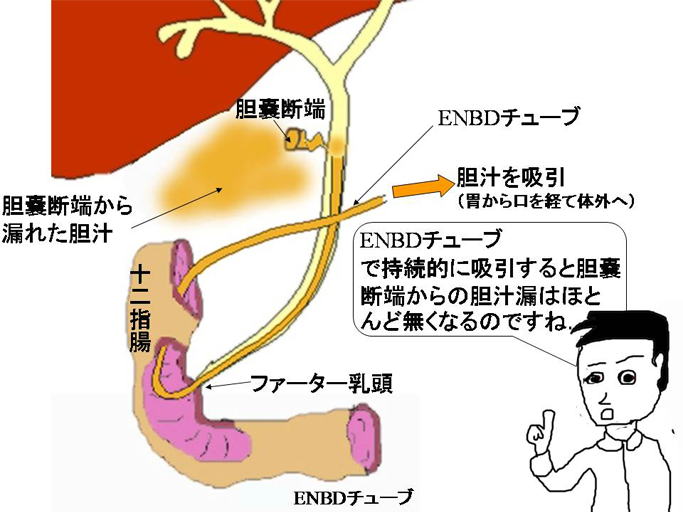 胆嚢 ポリープ 原因